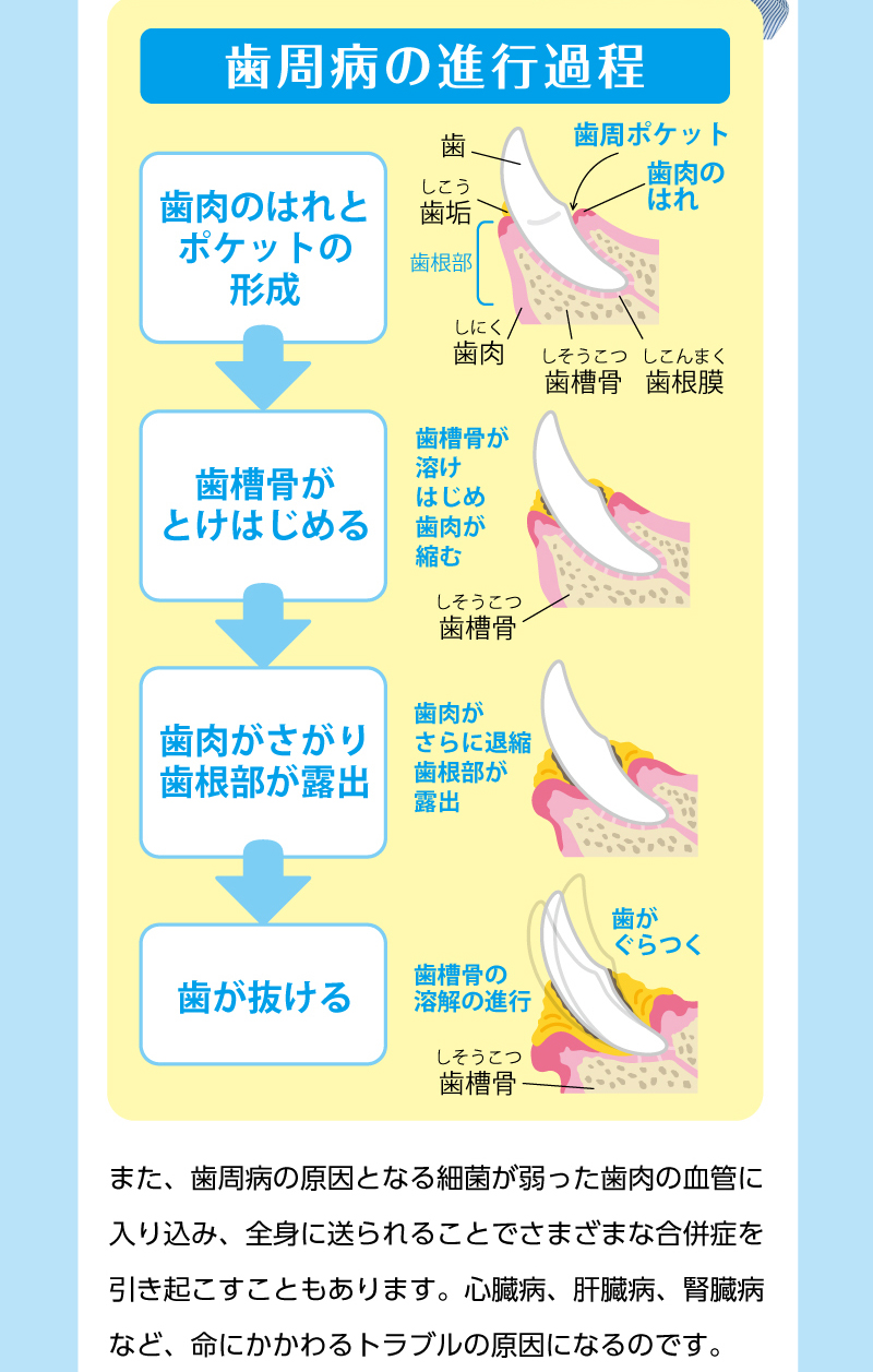 【歯周病の進行過程】歯肉のはれとポケットの形成→歯槽骨がとけはじめる→歯肉がさがり歯根部が露出→歯が抜ける　また、歯周病の原因となる細菌が弱った歯肉の血管に入り込み、全身に送られることでさまざまな合併症を引き起こすこともあります。心臓病、肝臓病、腎臓病など、命にかかわるトラブルの原因になるのです。